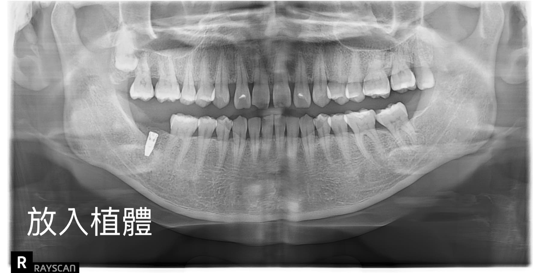 放入植體_適采