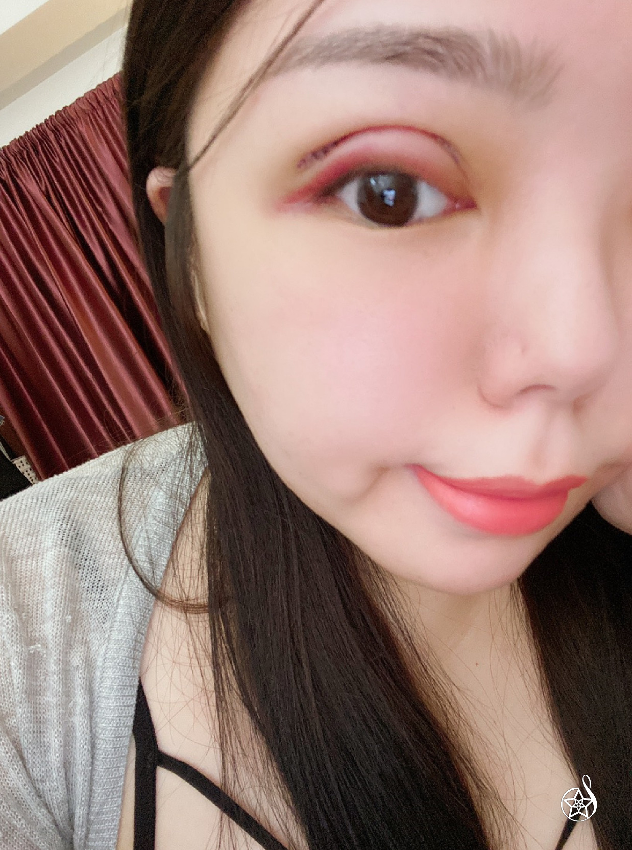 雙眼皮手術術後眼尾瘀青紀錄