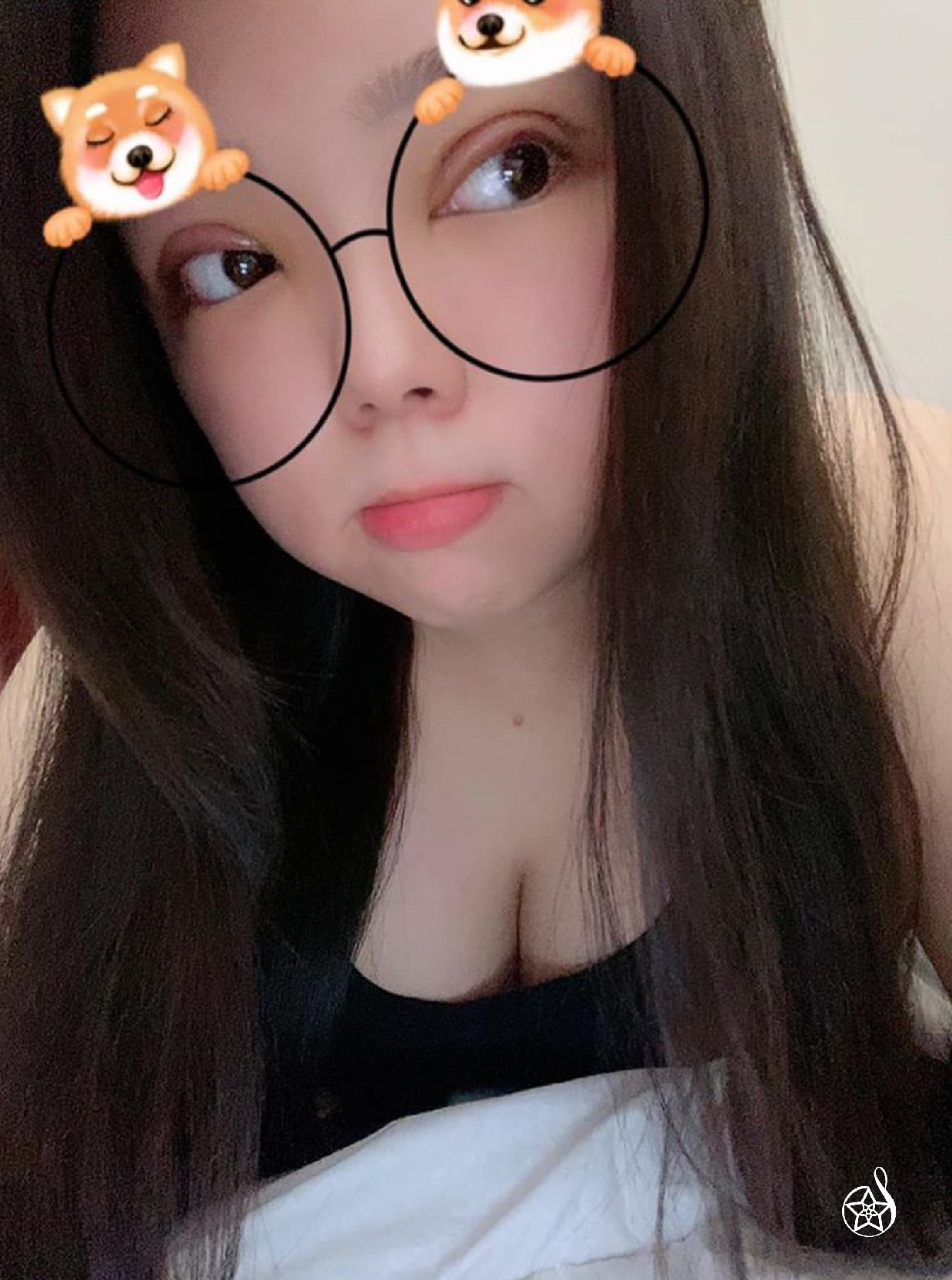 雙眼皮手術術後三天紀錄