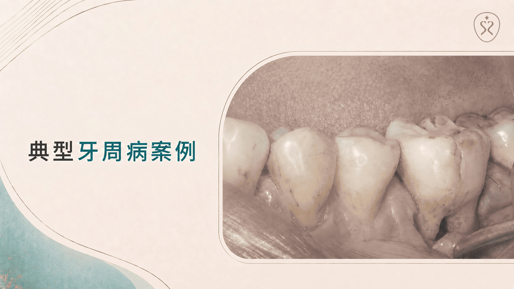 深層牙周囊袋與齒槽骨流失需進入正式牙周治療