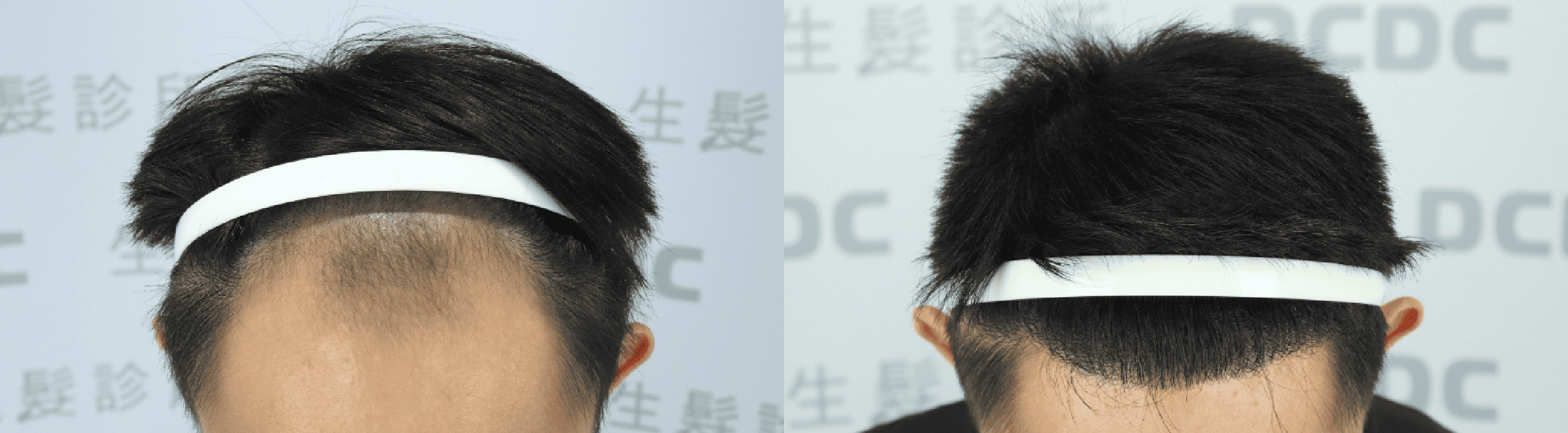 DCDC生髮診所-前額與M型髮際線植髮加密自然濃密效果