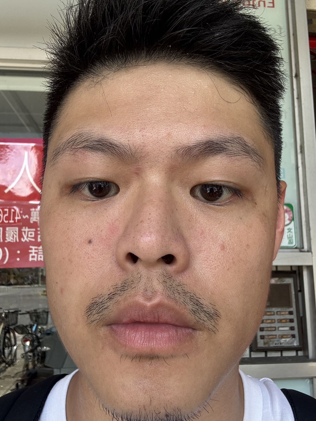 夏娃電波術前臉部與脖紋狀況-1