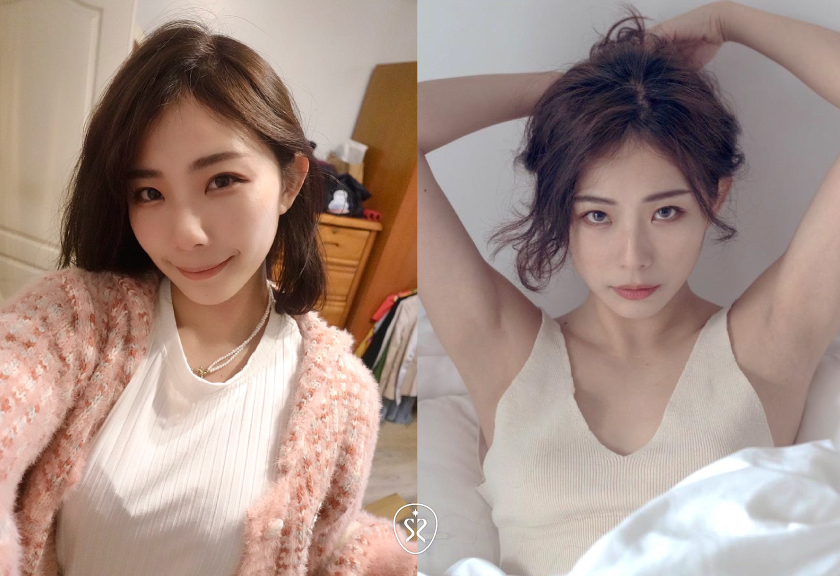玻尿酸術後完妝效果對比