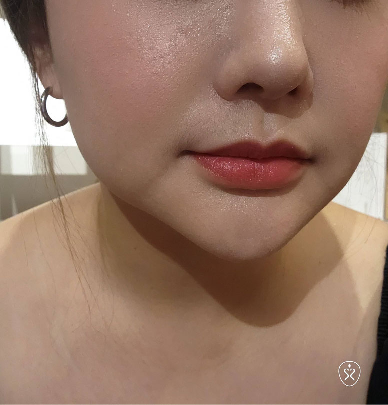 喬雅登玻尿酸不同劑型介紹