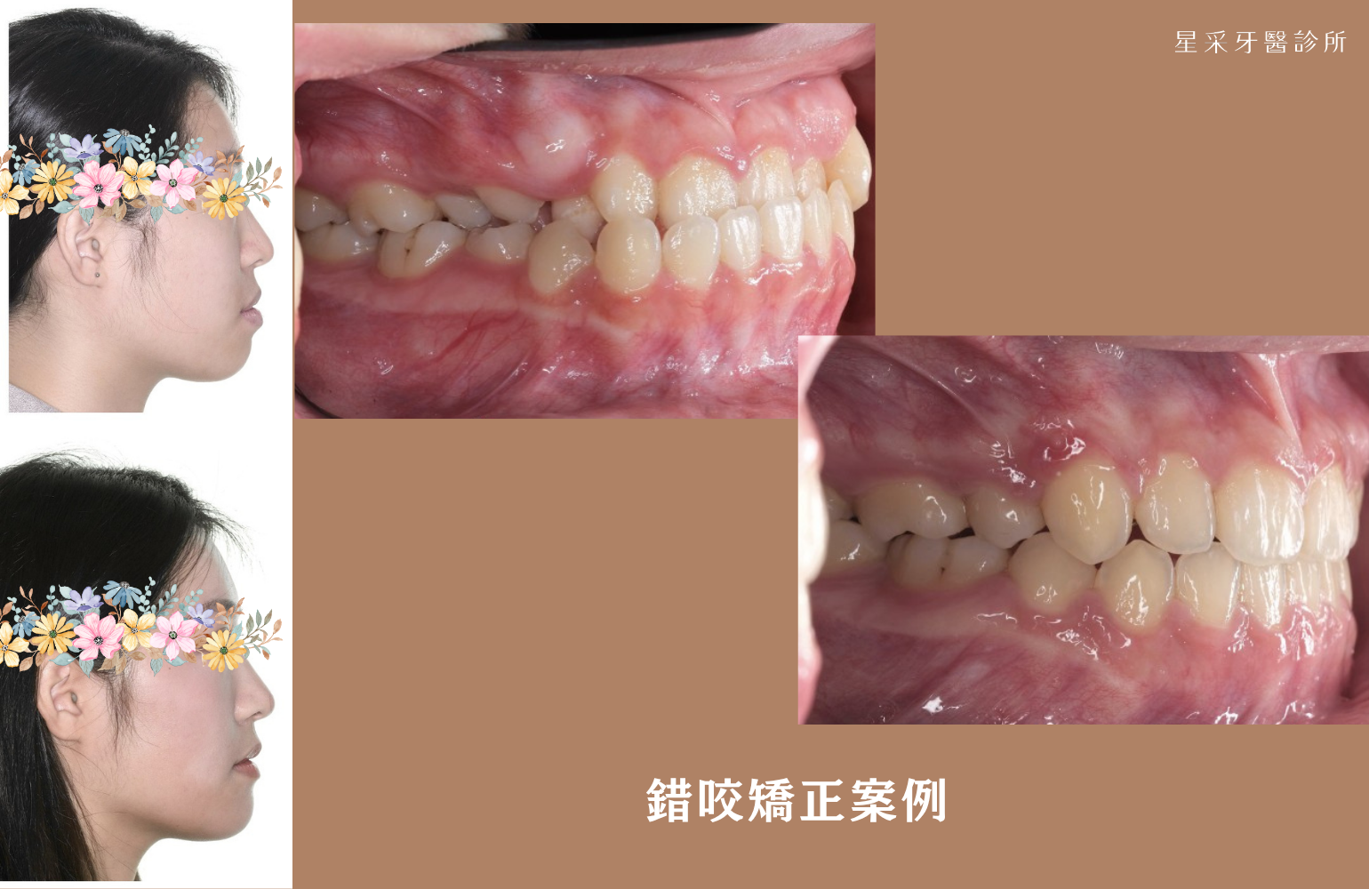 錯咬矯正案例-魏醫師壓星采logo