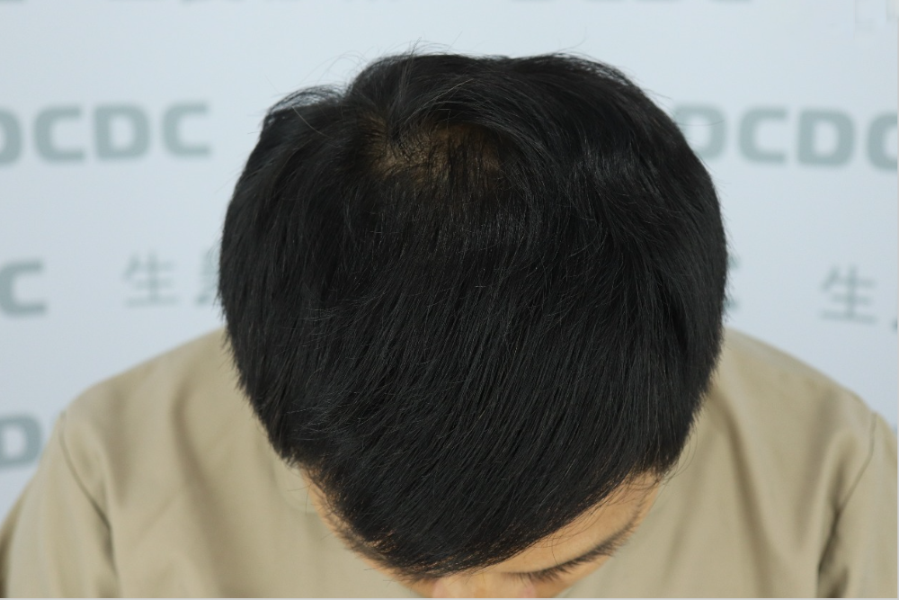 DCDC生髮診所-柯博桓醫師FUE植髮術前頭頂與髮旋稀疏評估