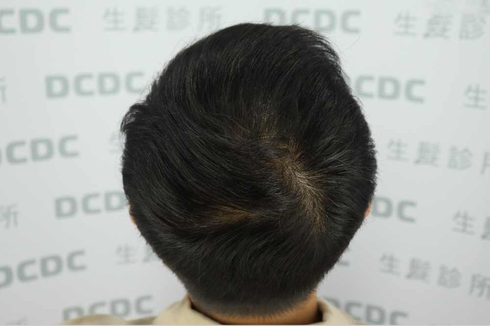 DCDC生髮診所-男性頭頂落髮科學化數據精算植髮根數