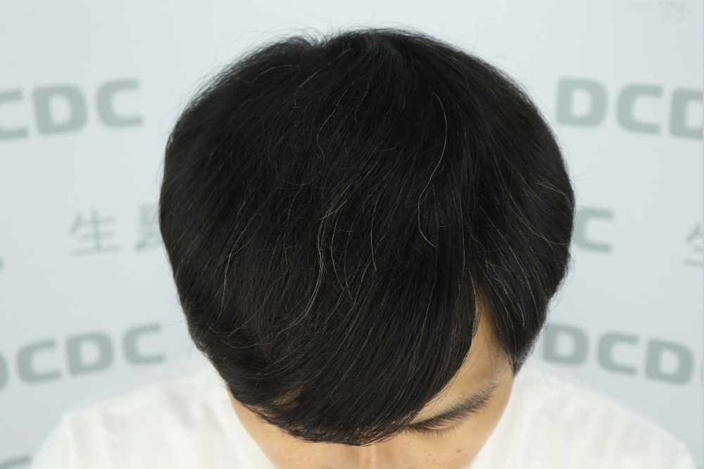 DCDC生髮診所-柯博桓醫師FUE植髮術後6個月頭頂濃密成果