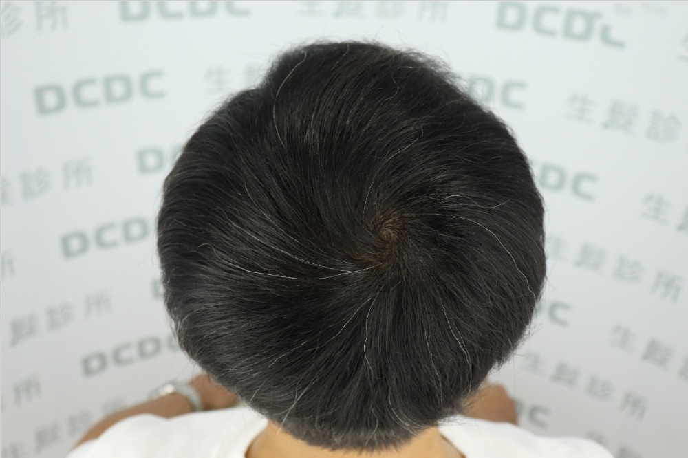 DCDC生髮診所-髮旋加密植髮術後6個月自然均勻視覺
