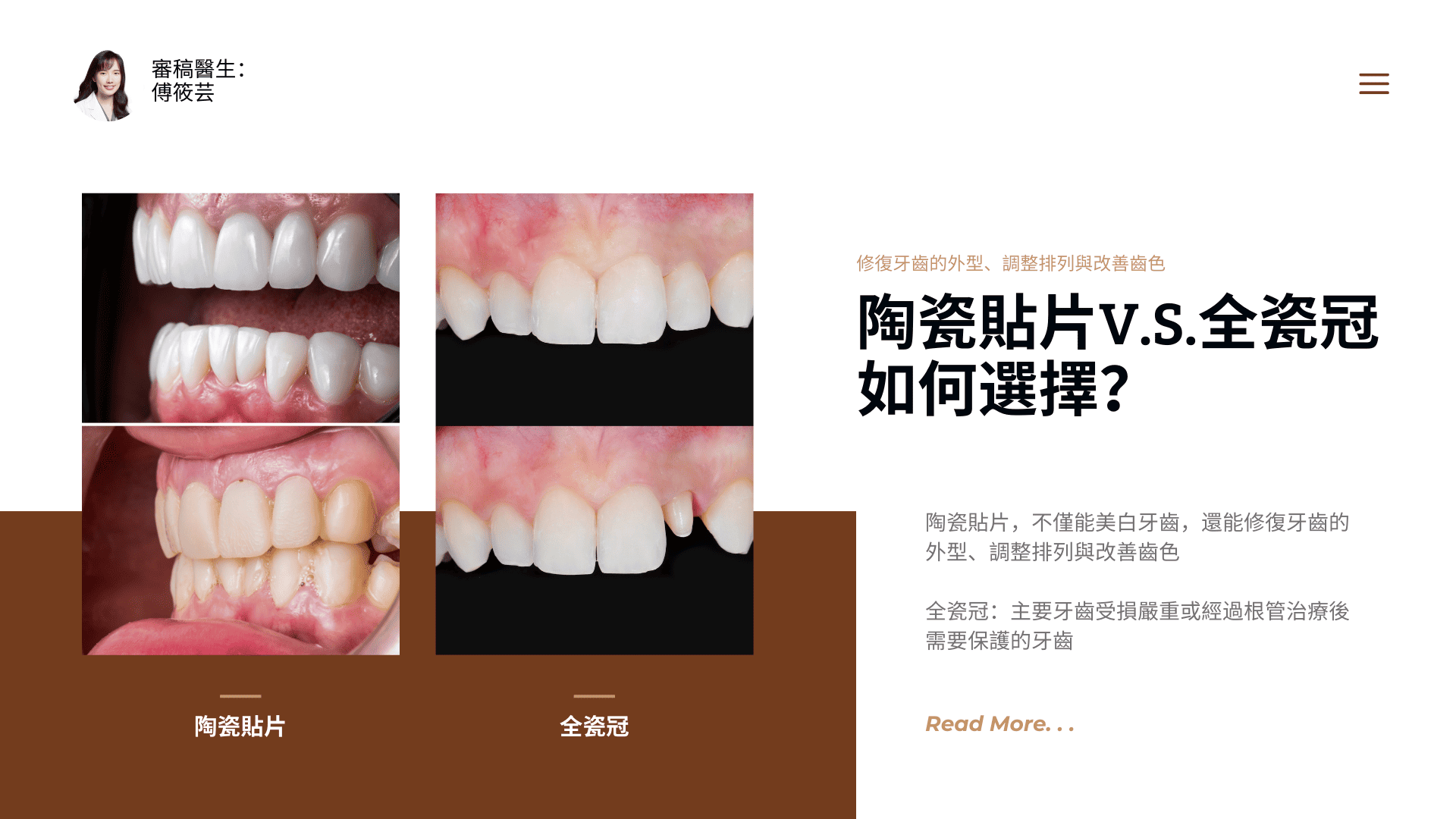 陶瓷貼片V.S.全瓷冠如何選擇？